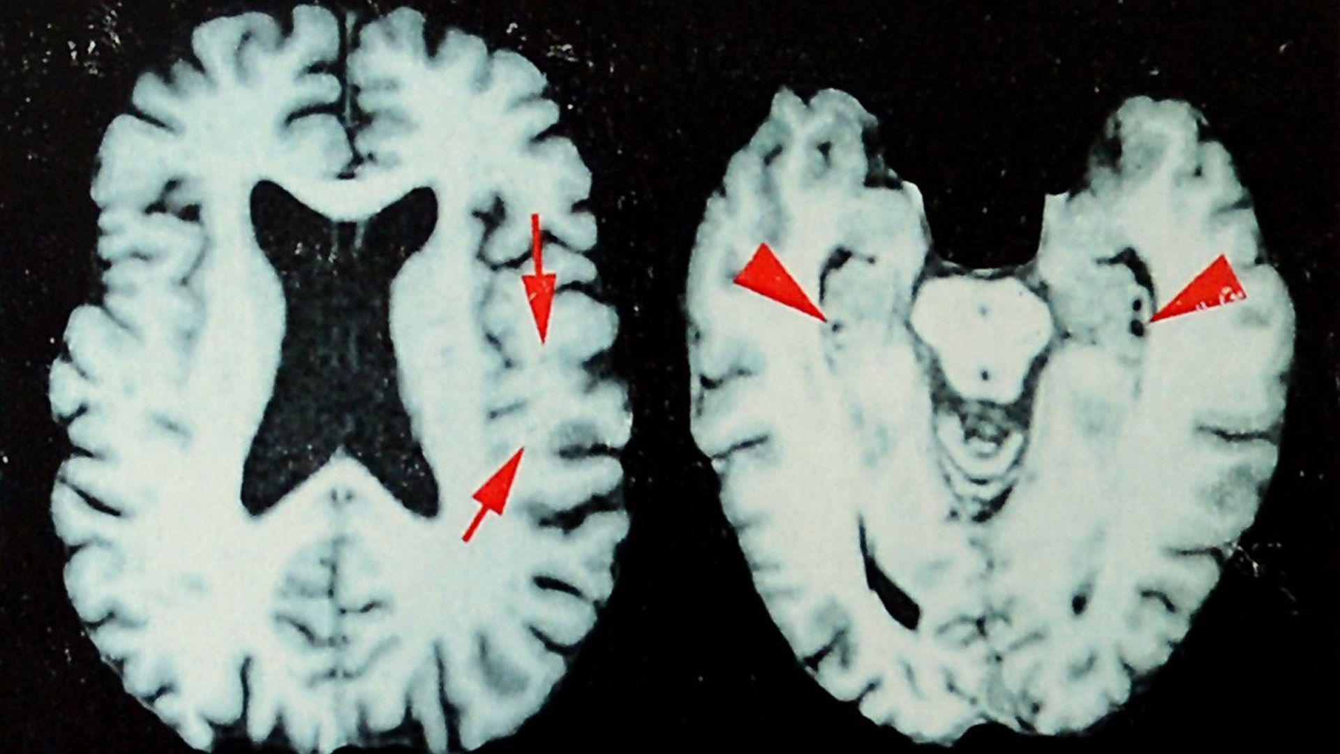 New Study Reveals Elevated Risk of Brain Disease Among Former NFL Players